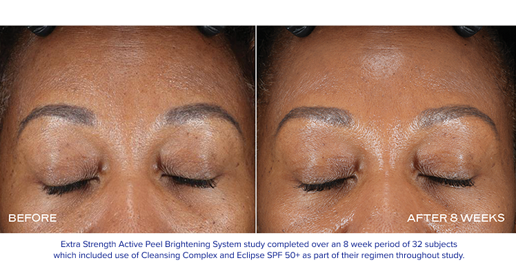 EXTRA STRENGTH ACTIVE PEEL BRIGHTENING SYSTEM