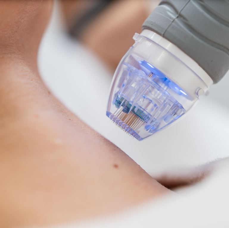 Post-Microneedling/ -Laser/ -Ablative Behandlungen