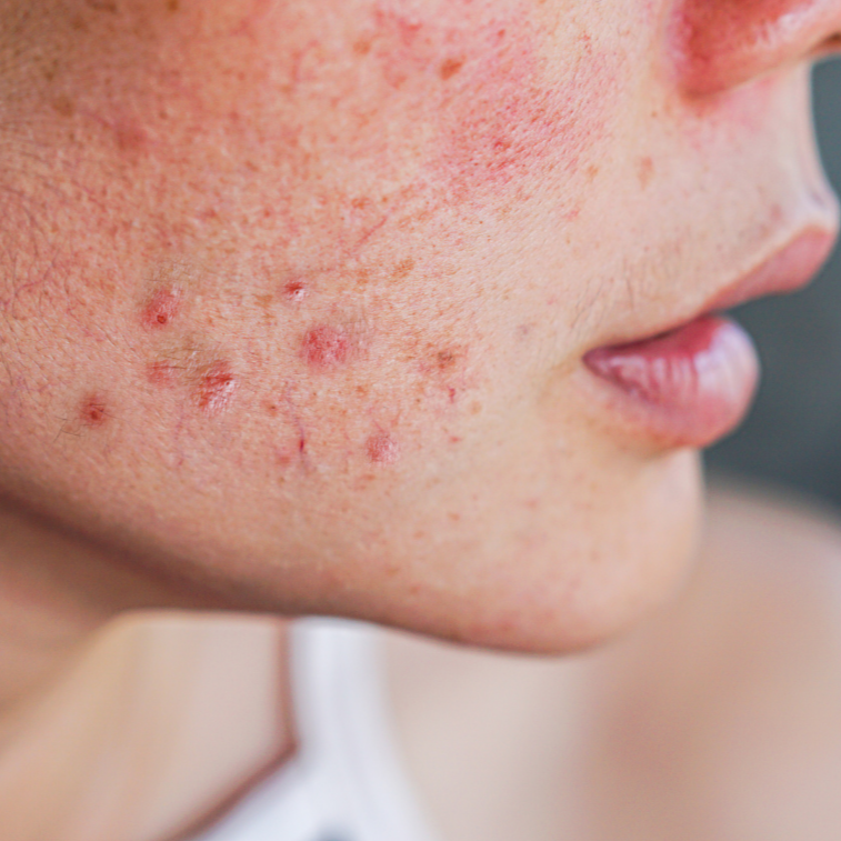 Rosazea / Rosacea / Couperose