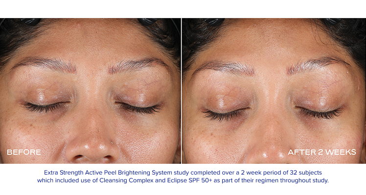 EXTRA STRENGTH ACTIVE PEEL BRIGHTENING SYSTEM