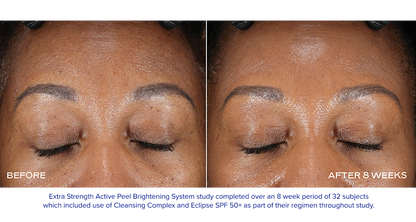 EXTRA STRENGTH ACTIVE PEEL BRIGHTENING SYSTEM